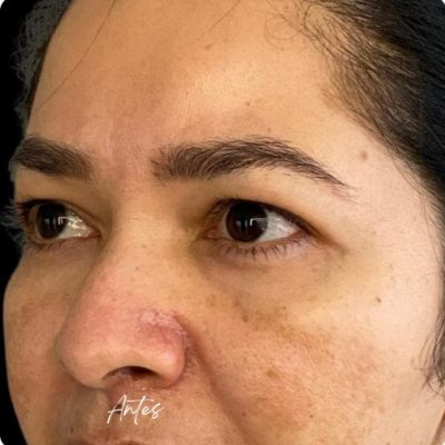 blefaroplastia_1_9