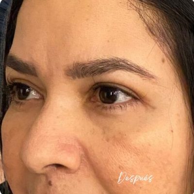 blefaroplastia_1_10