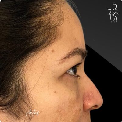 blefaroplastia_1_11