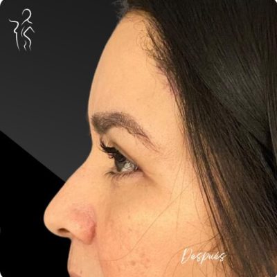 blefaroplastia_1_12